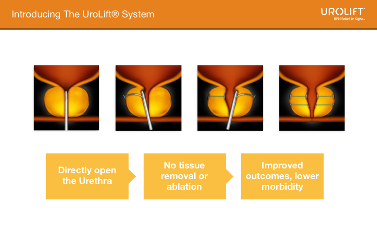UroLift System